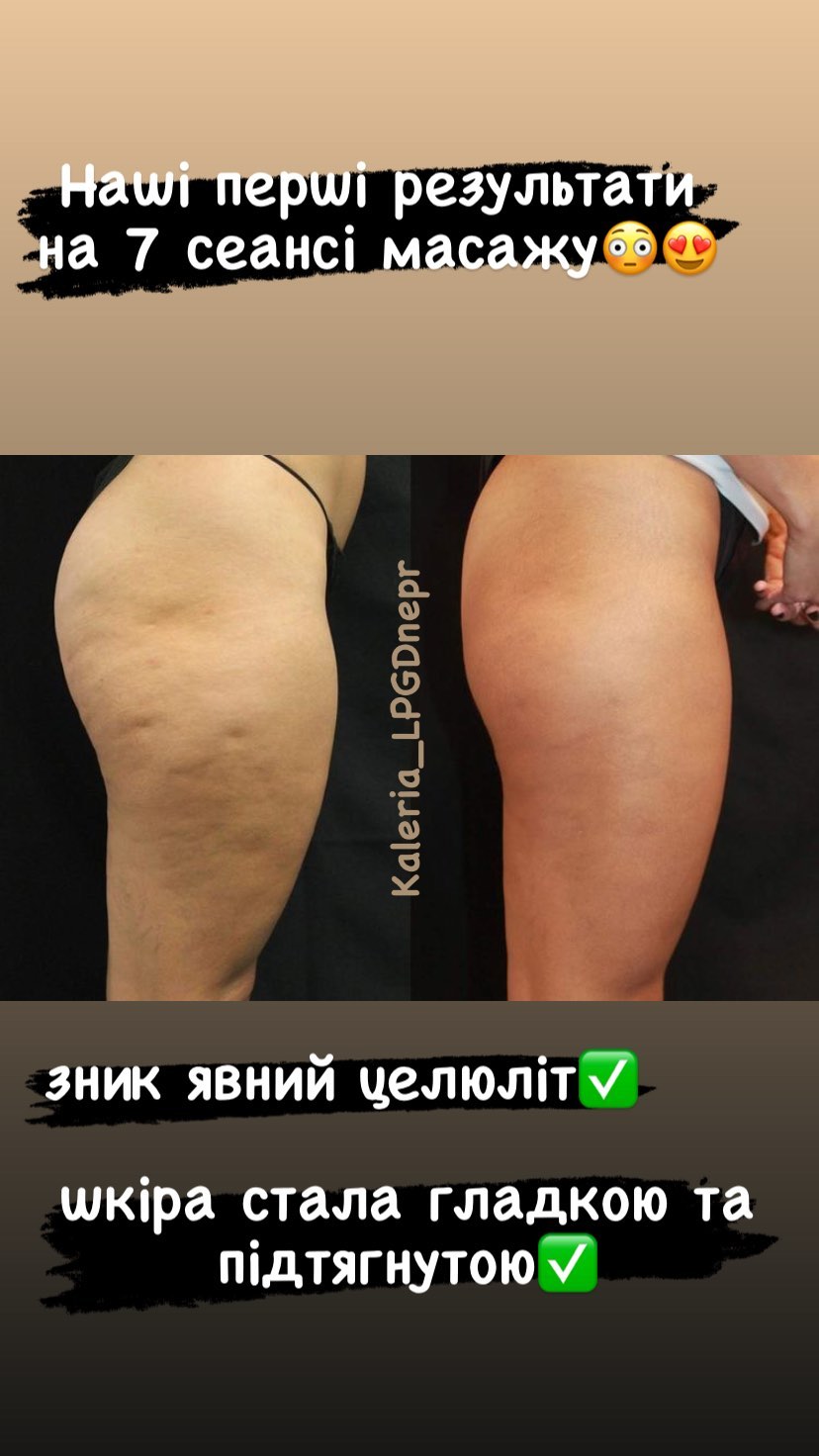 Вібромасаж G5 до і після